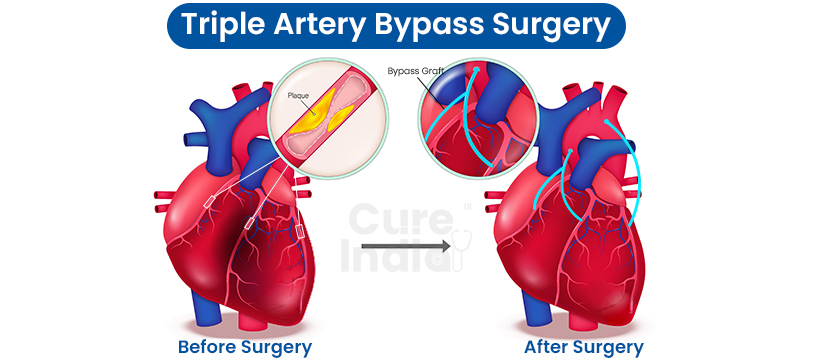 Triple artery bypass surgery in India